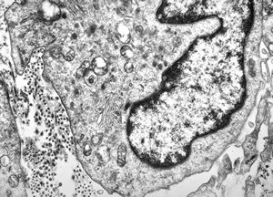 M, 7m. | histiocytosis X (eosinophilic granuloma) … Langerhans cell